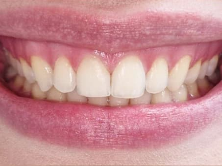 Установка брекетов для ровных зубов