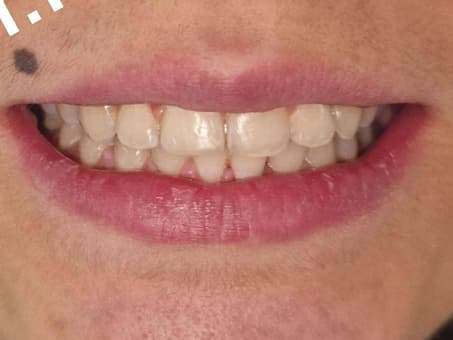 Выравнивание зубов металлическими брекетами