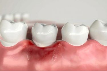 Отторжение импланта зуба: признаки, о которых важно знать
