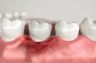 Отторжение импланта зуба: признаки, о которых важно знать, статья на Eurodent