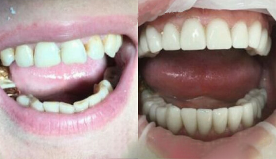 Протезирование винирами