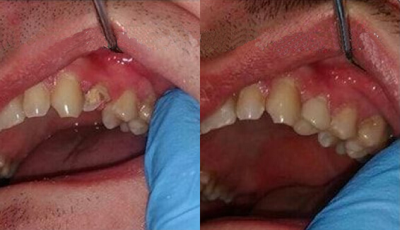 Установка керамических вкладок