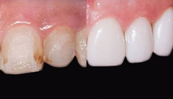 Установка зубных виниров