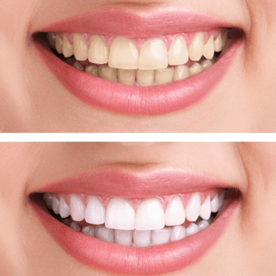 На изображении показана разница оттенка зубов после процедуры отбеливания, Евродент фото
