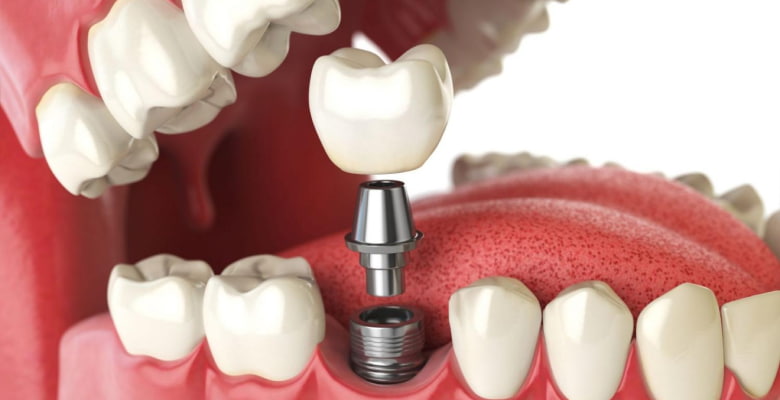 На изображении, схематически показана процедура имплантации зубов