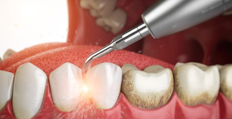На изображении, показан процесс процедуры чистки зубного камня