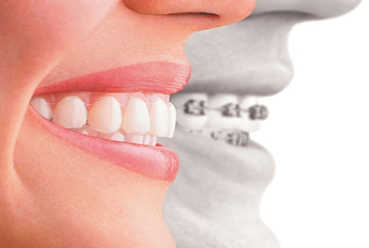 Как выровнять зубы? Сапфировые брекеты: комфортные «невидимки», верхнее фото
