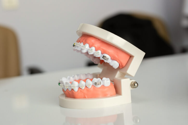 Брекеты на зубы металлические, фото Евродент