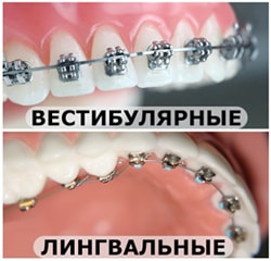 Вестибулярные и лингвальные брекеты в стоматологии, фото от Евродент 