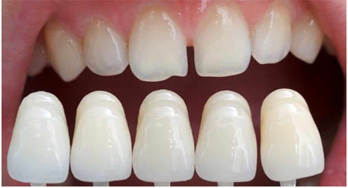способы лечения эмали зубов