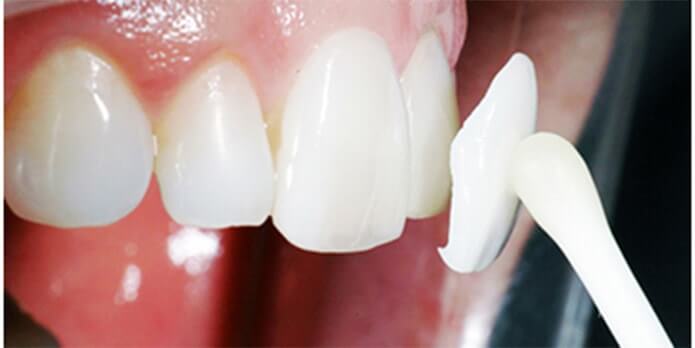 ультраниры в микропротезировании зубов