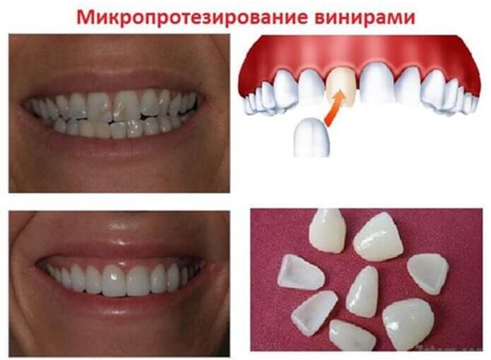 результат установки ультраниров на зубы