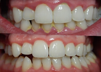 Зубной налет на десне, фото