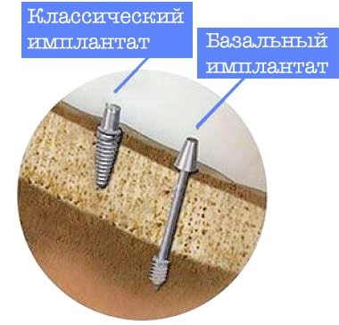 Отличие классических имплантов зуба от базальных, фото Евродент