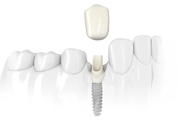 Экспресс имплантация зубов – быстрое восстановление красивой улыбки, верхнее фото