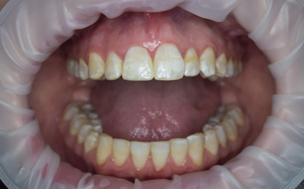 Лечение флюороза эмали зубов, фото Евродент