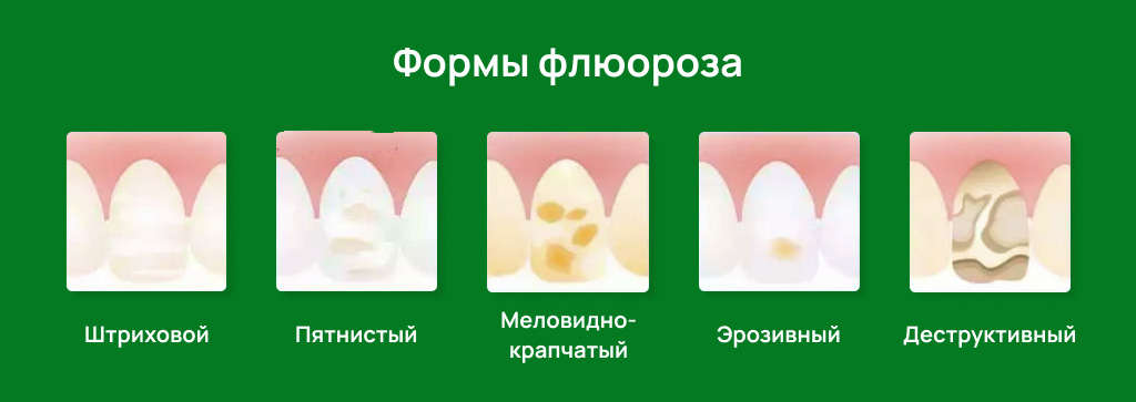 Формы флюороза зубов, фото Евродент