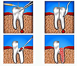 Что такое гемисекция корня зуба, фото eurodent.kz 
