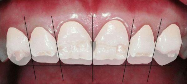 некариозные заболивания зубов