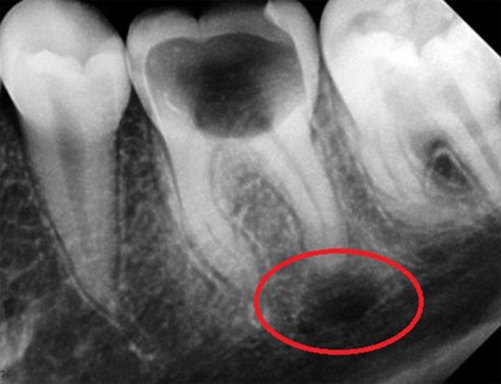 Причины возникновения гранулемы зуба. Евродент фото