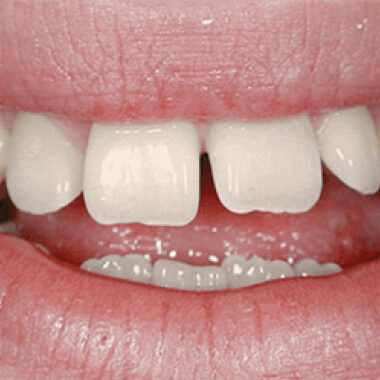 Реставрация зубов до, фото Евродент