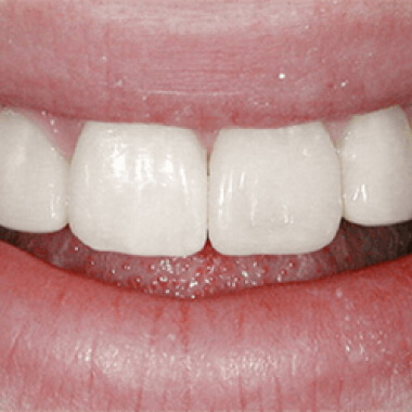 Реставрация зубов после, фото Евродент