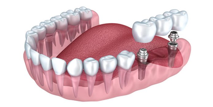 Преимущества имплантации зубов - Евродент, фото