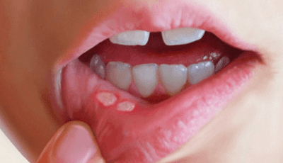 Кандидоз полости рта, фото 2