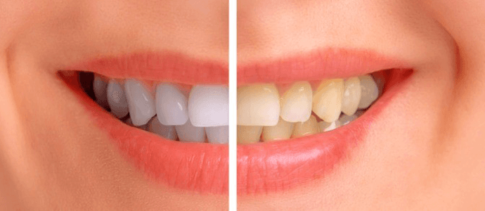 Капы для отбеливания зубов, фото 3
