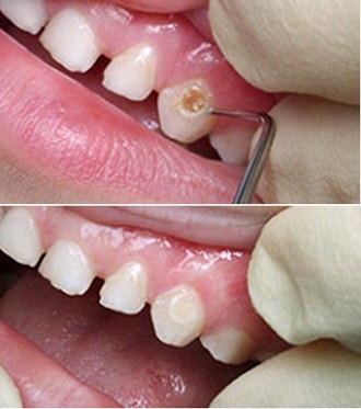 Проявление кариеса молочных зубов, фото 1