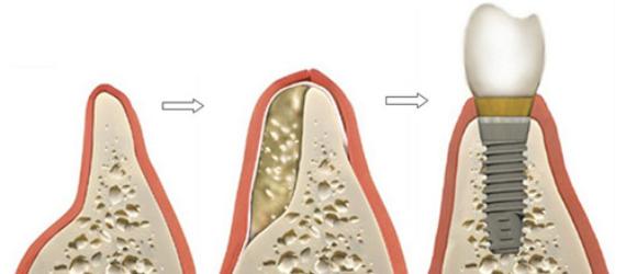 Схема наращивания челюстной кости, фото Евродент