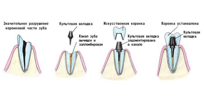 процесс установки культевой вкладки на зуб