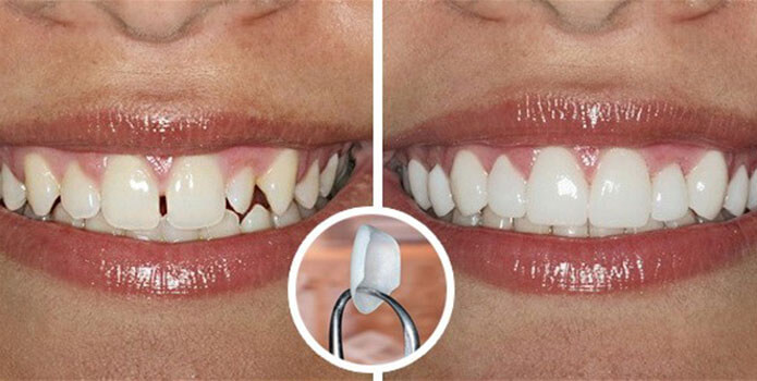Люминиры без обточки зубов цена цди томск стоматология