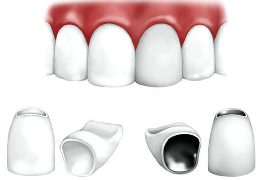 Металлокерамические коронки презентация