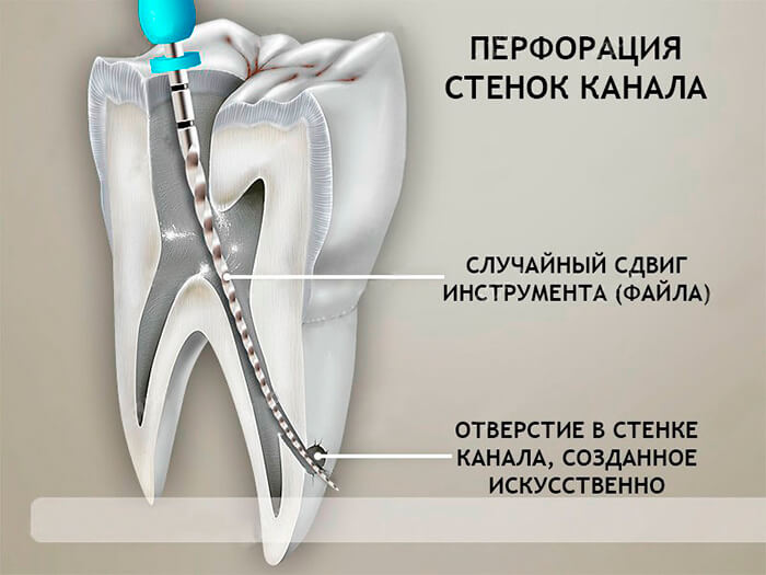 ошибки и осложнения в стоматологии, фото Eurodent