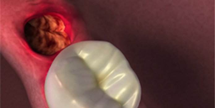 "Сухая лунка" - осложнения после удаления зуба, Евродент фото