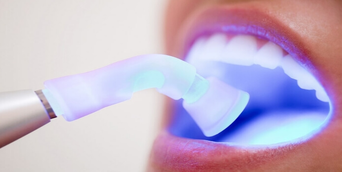 лазерное отбеливание зубов, фото