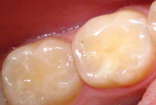 Типы пломбирования зубов