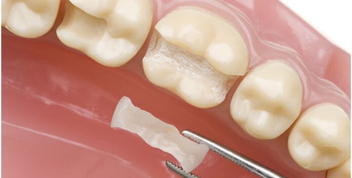Лечение зубов временными пломбами