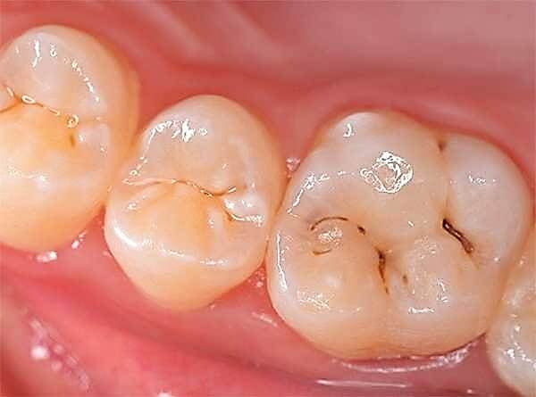Профилактика кариеса: как сохранить здоровье зубов