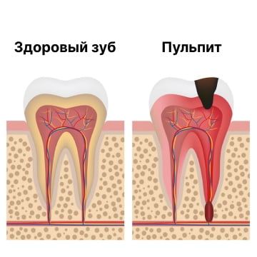 Изображение зуба в разрезе, на котором видно разницу здорового зуба и зуба с пульпитом , фото Евродент