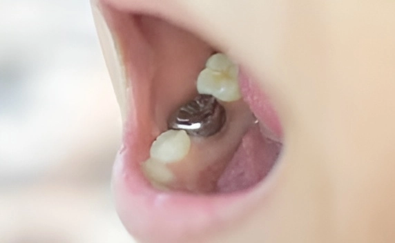 Восстановление части молочного зуба с помощью коронки