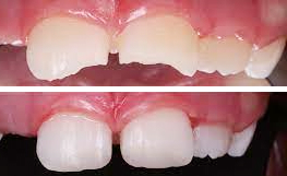 Реставрация скола передних молочных зубов