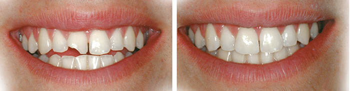 Сколы на передних зубах и их художественная реставрация, фото Евродент