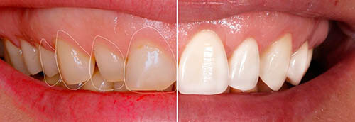 реставрация передних зубов, фото