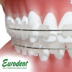 Как выровнять зубы с помощью сапфировых брекетов - Евродент, фото №1