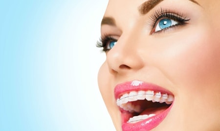 Красивая улыбка в  сапфировых брекетах - Евродент, фото №2