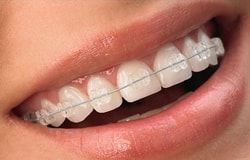 Улыбка в  сапфировых брекетах от стоматологии Евродент, фото №3