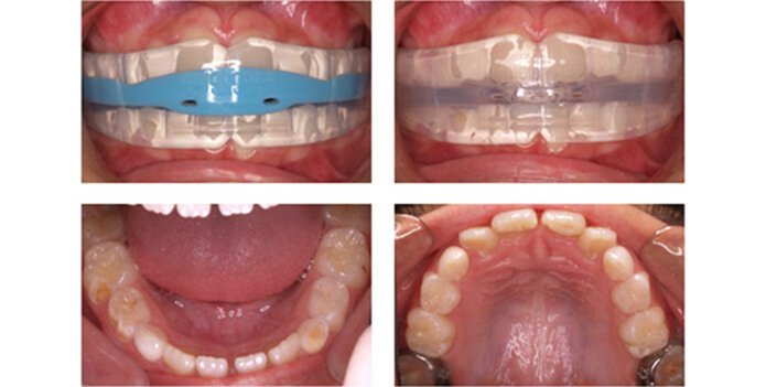 этапы выбора трейнера для зубов