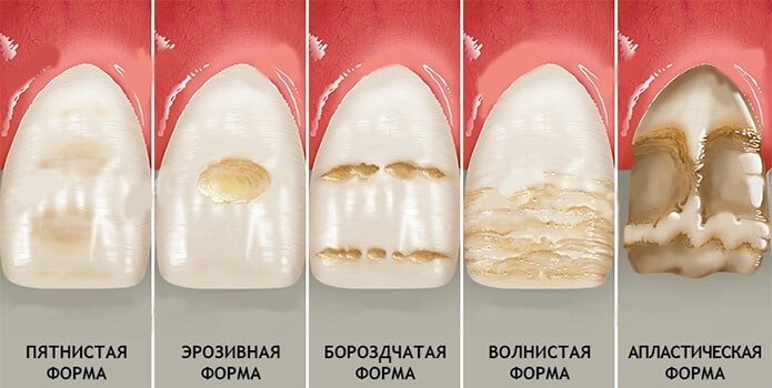 формы гипоплазии эмали зубов